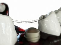 Implant dentar ieftin